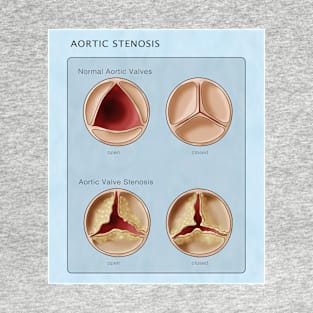 Medical Illustration of Heart Valves, Normal & Stenosis T-Shirt